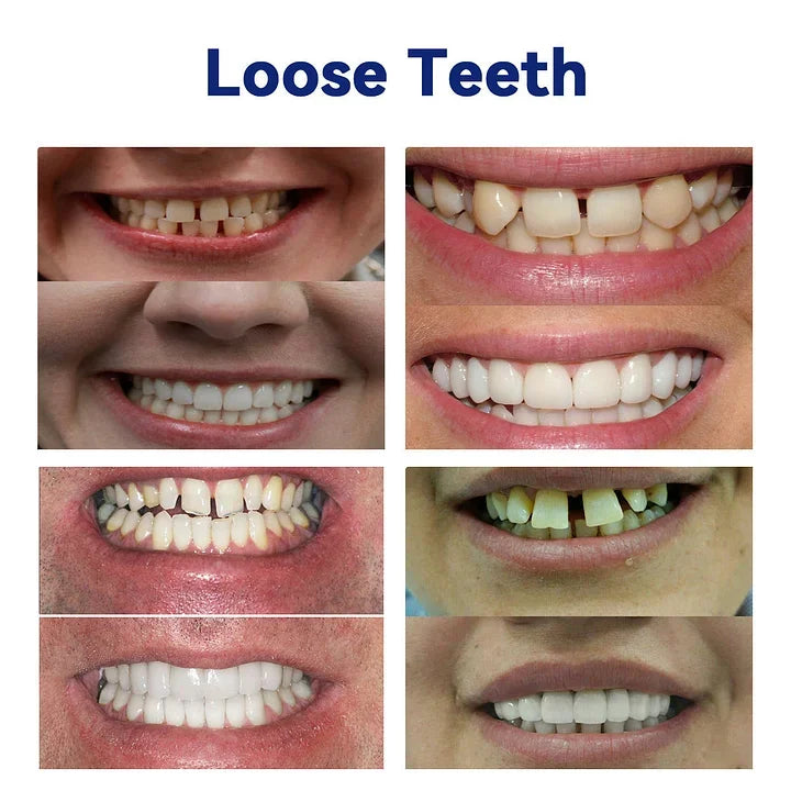 SmileFitPro – PRossoesi dentale flessibile di nuova generazione