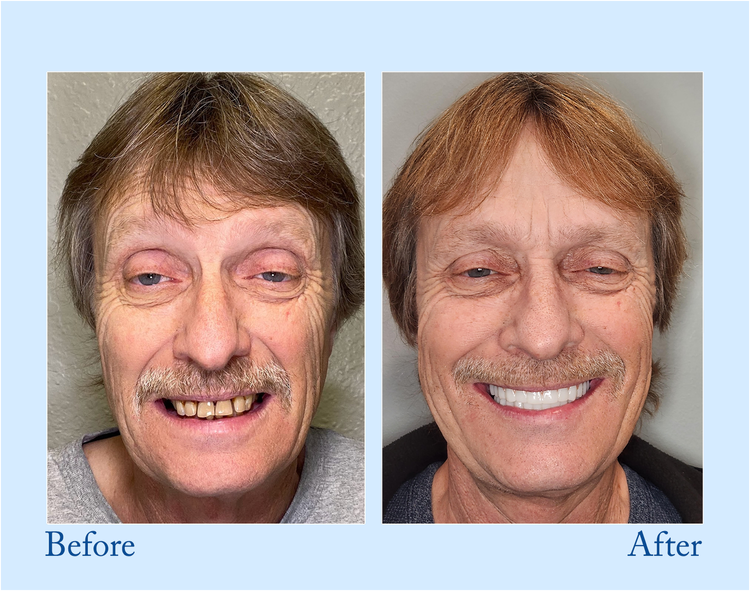 Smileasego – PRossoesi dentale completa premium per un sorriso naturale