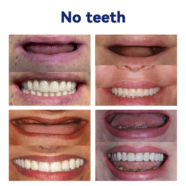 SmileFitPro – PRossoesi dentale flessibile di nuova generazione